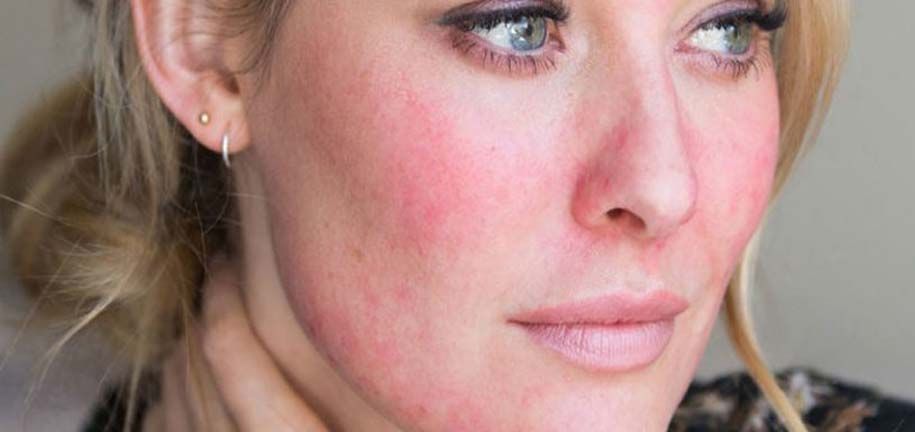 乾燥して刺激を受けたスキンケア