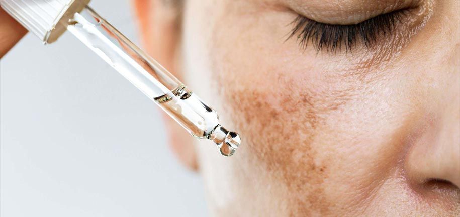 シミ・色素沈着を効果的に治す方法