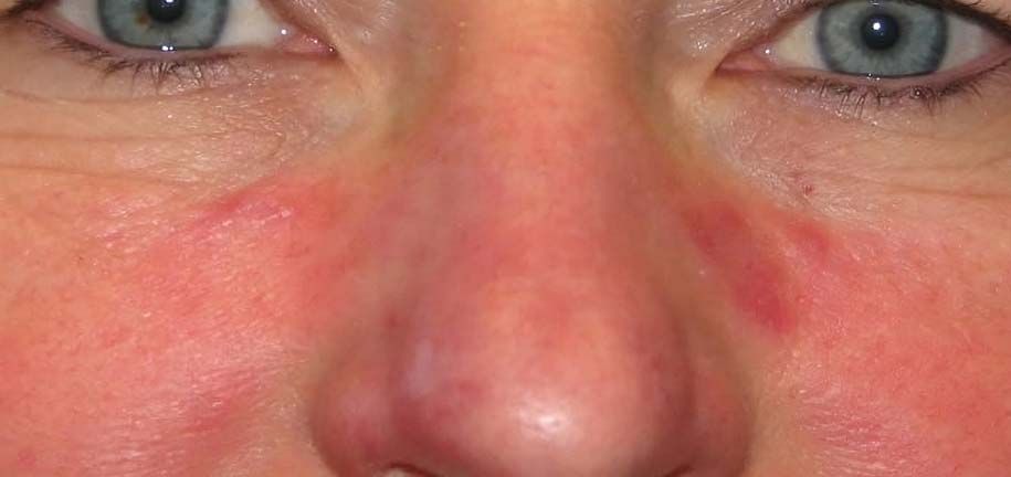 脂漏性肌のルーティン